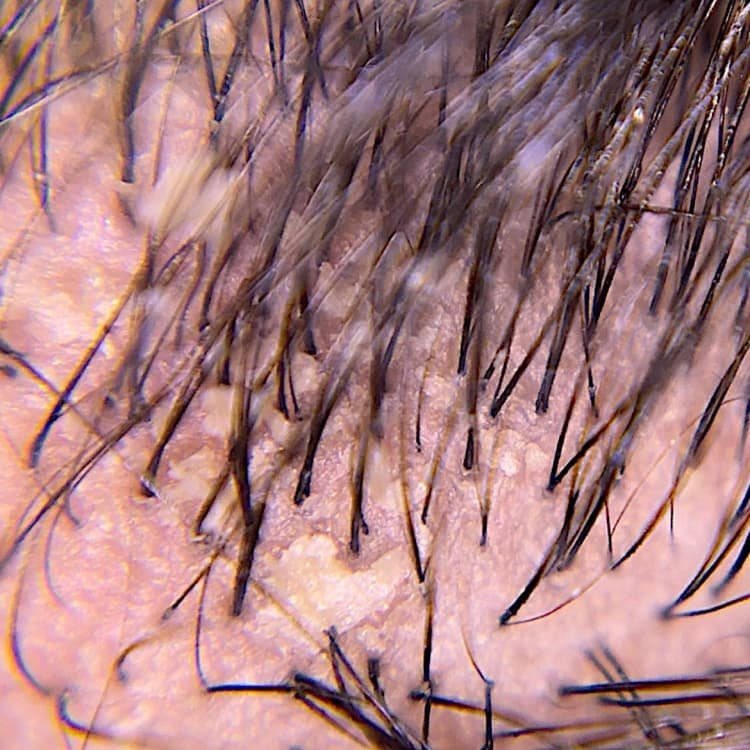 Close-up of a flaky scalp with visible dandruff, illustrating the need for targeted and effective scalp care and treatment